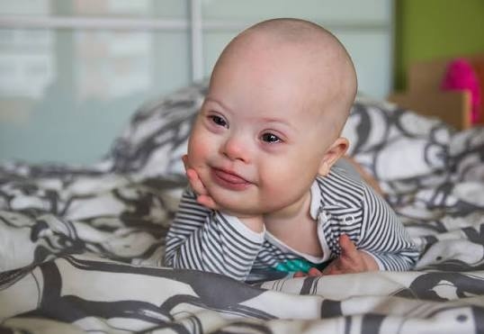 Ciri Fisik Anak Down Syndrome yang Harus Dikenali Orang Tua