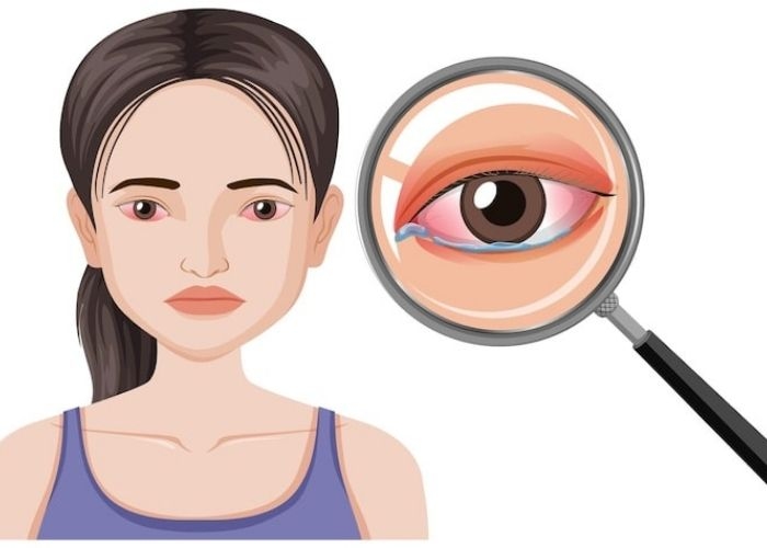 Cara Melindungi Mata dari Abu Vulkanik, Ikuti 7 Tips Ini agar Tidak Iritasi