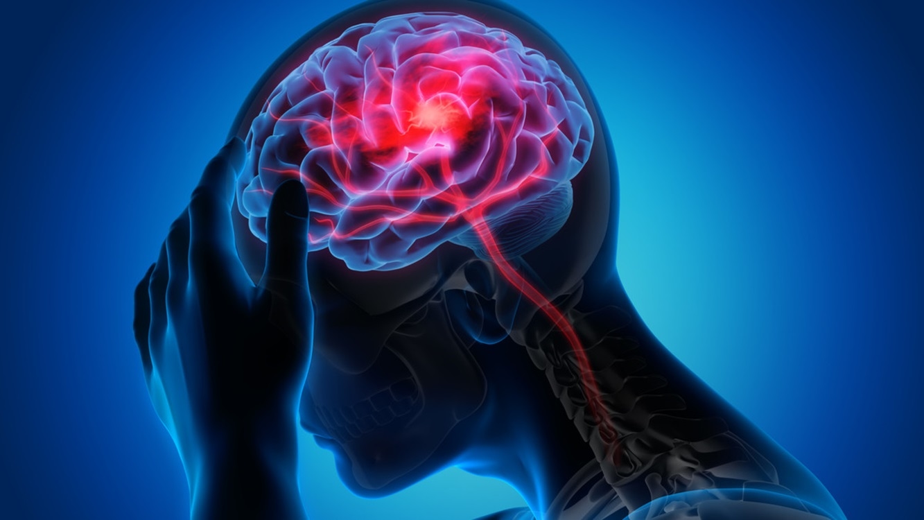 Sering Dianggap Sepele, Ternyata Ini Bahaya Mini Stroke yang Wajib Diwaspadai
