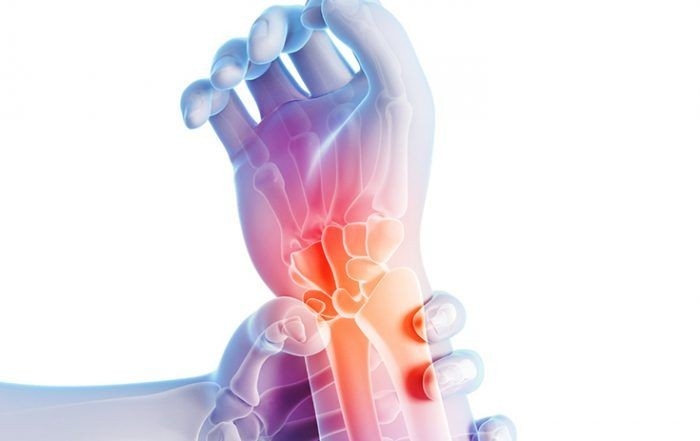 Kenali Apa Itu Carpal Tunnel Syndrome, Lengkap Pengobatannya