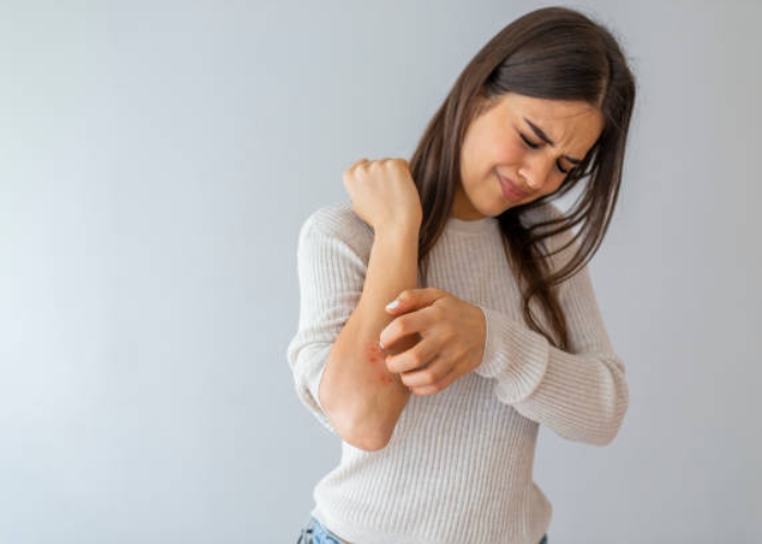 Benarkah Urticaria Bisa Timbul Karena Stres? Ini Penjelasannya