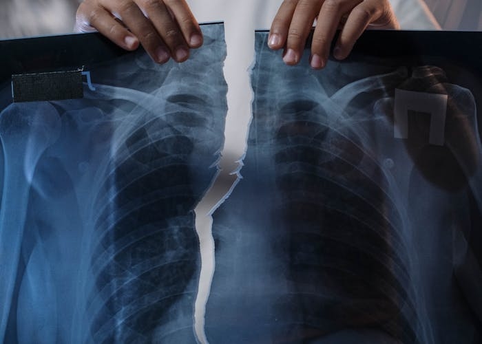 Polo Srimulat Meninggal karena Penyakit Paru-paru, Ini Kebiasaan Pemicunya