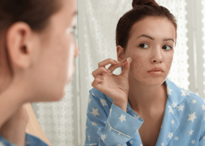 Lagi Tren! Ternyata Ini Manfaat Acne Patch yang Wajib Diketahui