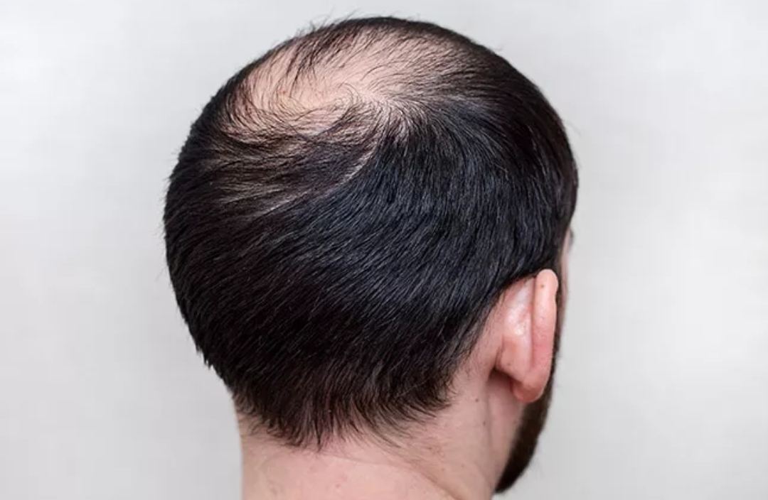 Cara Merawat Rambut Rontok pada Pria secara Alami Tanpa Obat