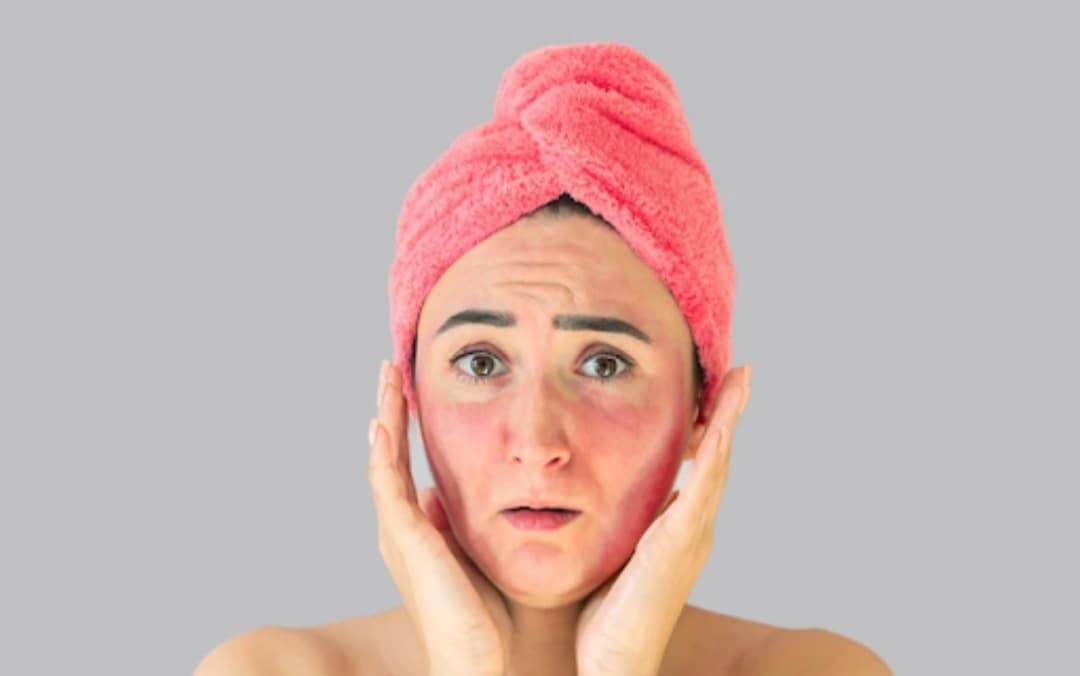 Cara Merawat Kulit Wajah Setelah Terbakar Matahari