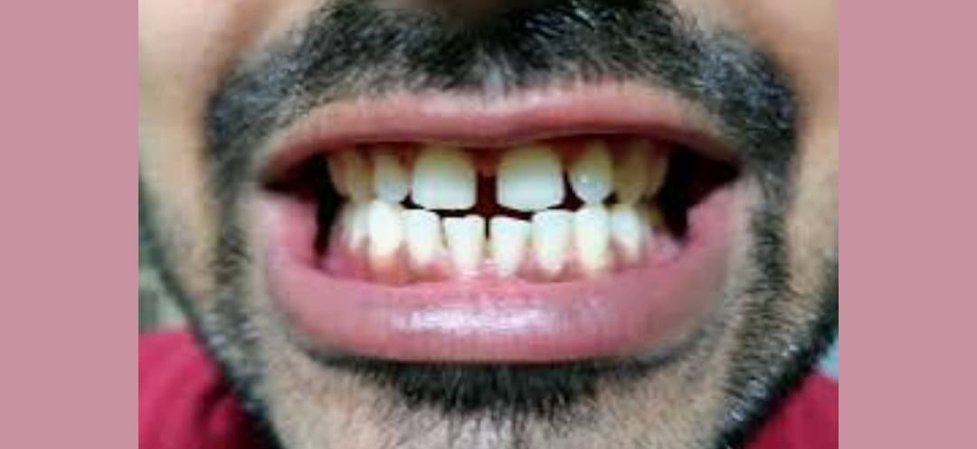 Gigi Renggang (Diastema): Penyebab, Ciri, dan Cara Mengobatinya